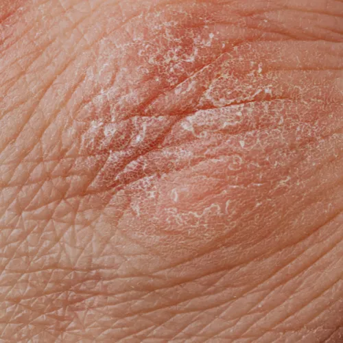 A detailed, square close-up photograph of human skin showing a patch of psoriasis. The skin is red, inflamed, and covered with characteristic silver-white scaling and dry, flaky patches, indicating a common skin condition.
