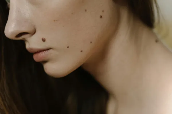 Unusual moles on skin that may indicate underlying health concerns